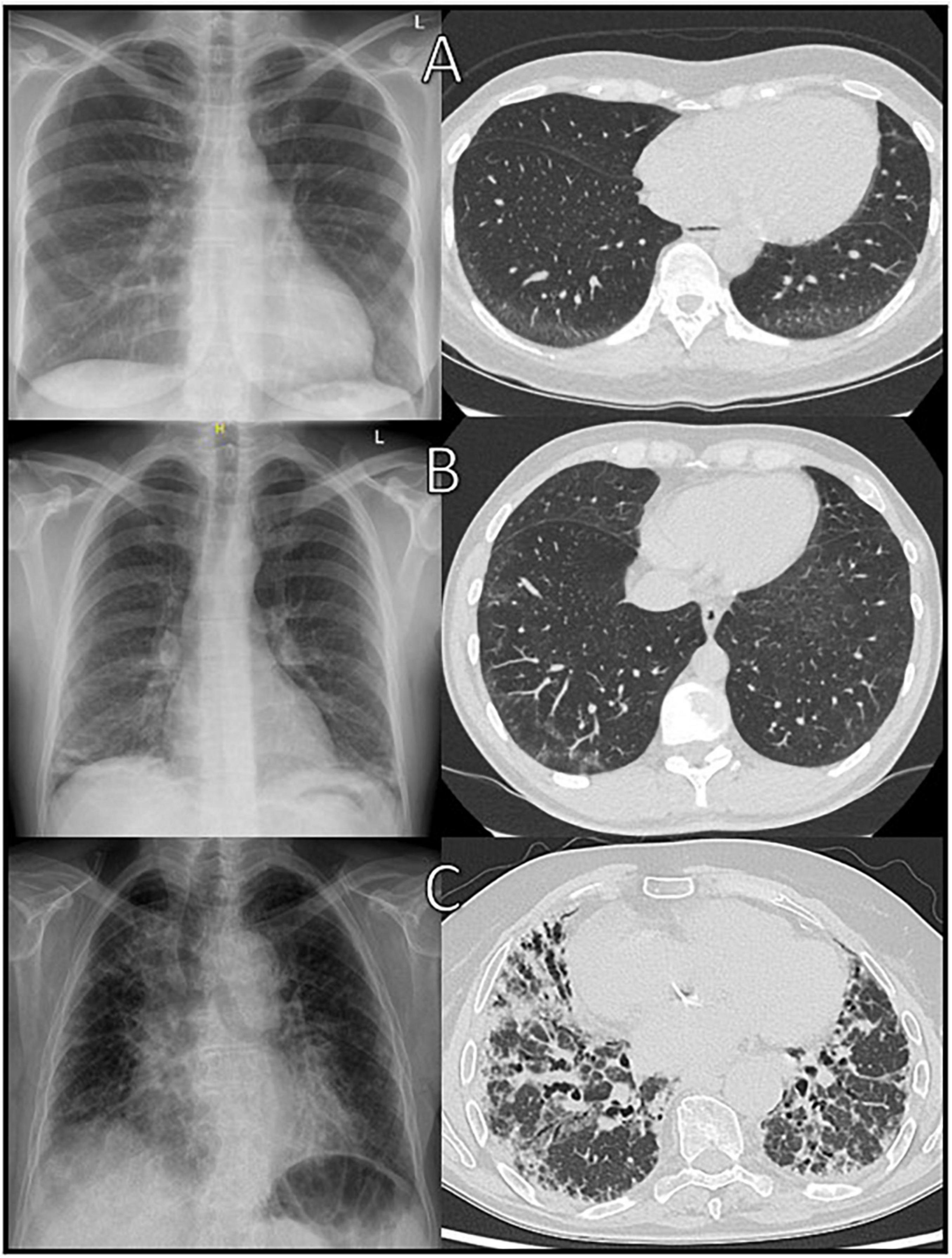 Diagnosing lung involvement in inflammatory rheumatic diseases—Where do we currently stand?